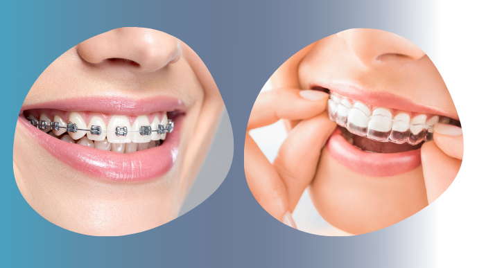 Ortodoncia invisible vs. brackets tradicionales, ¿cuál elegir?