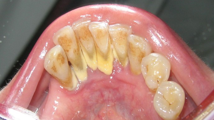 ¿Qué es el sarro dental y cómo se elimina?