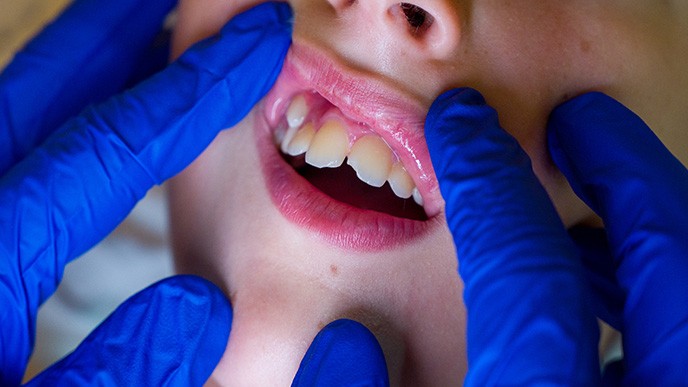 ¿Qué hacer si se rompe un diente? Primeros auxilios y soluciones dentales