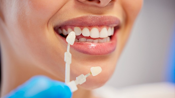 130216_blanqueamiento-dental.jpg